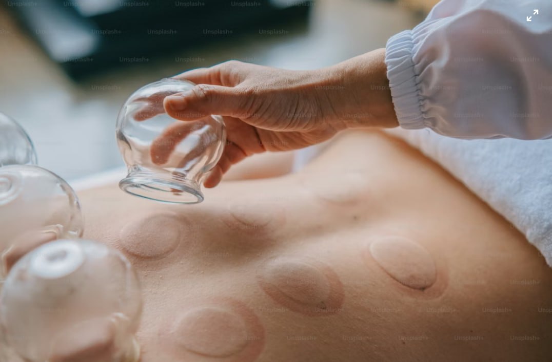 Cupping therapy treatment